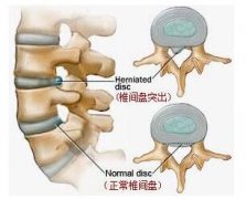 腰椎间盘突出症的危害有哪些?